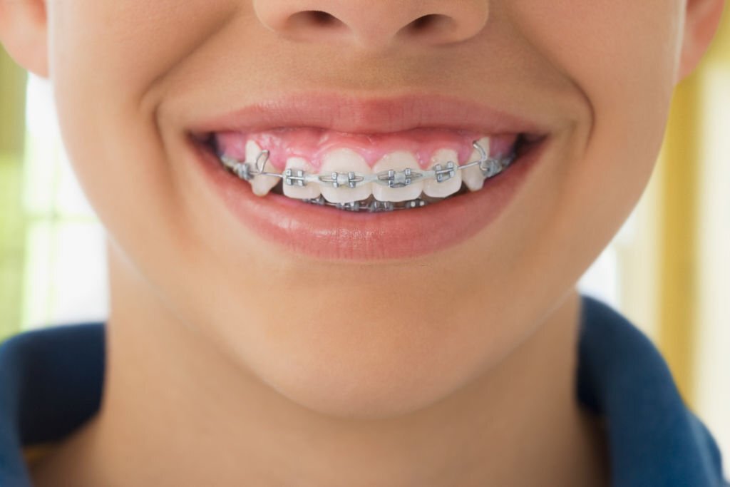 How to Remove Braces at Home 