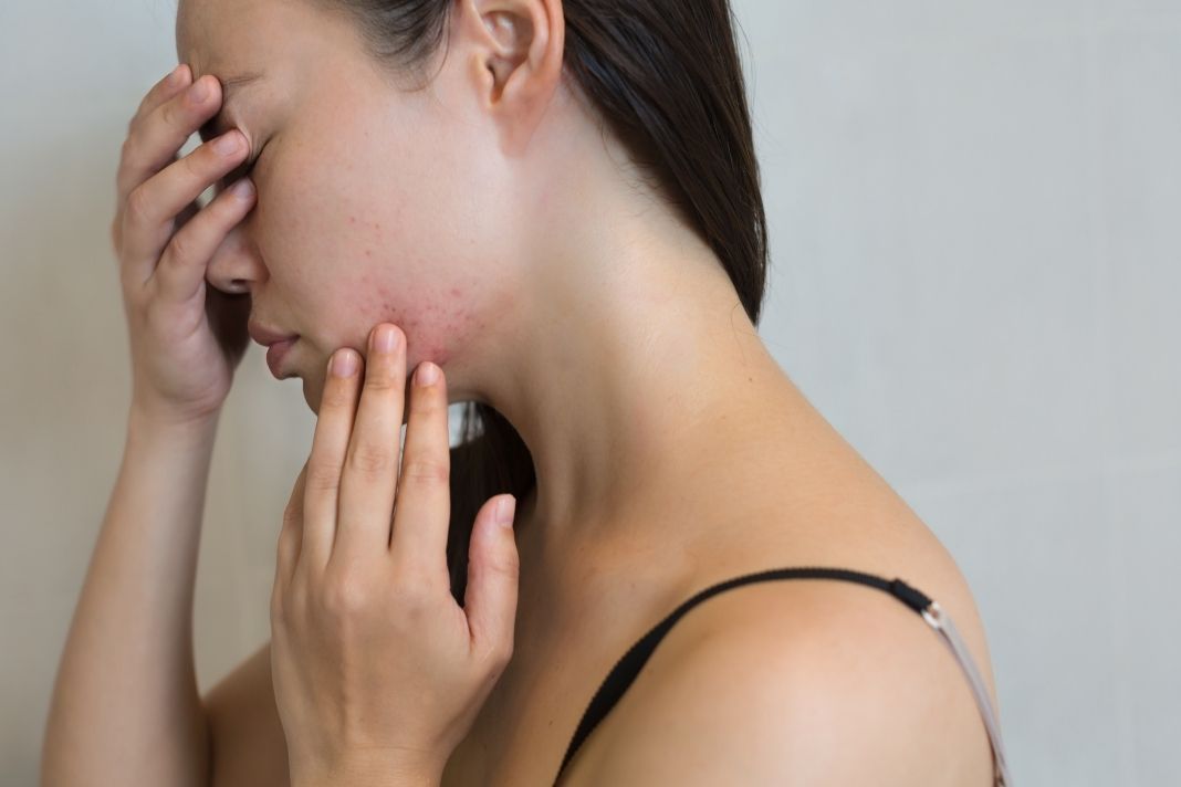 Should You Squeeze the Clear Liquid Out of a Pimple?