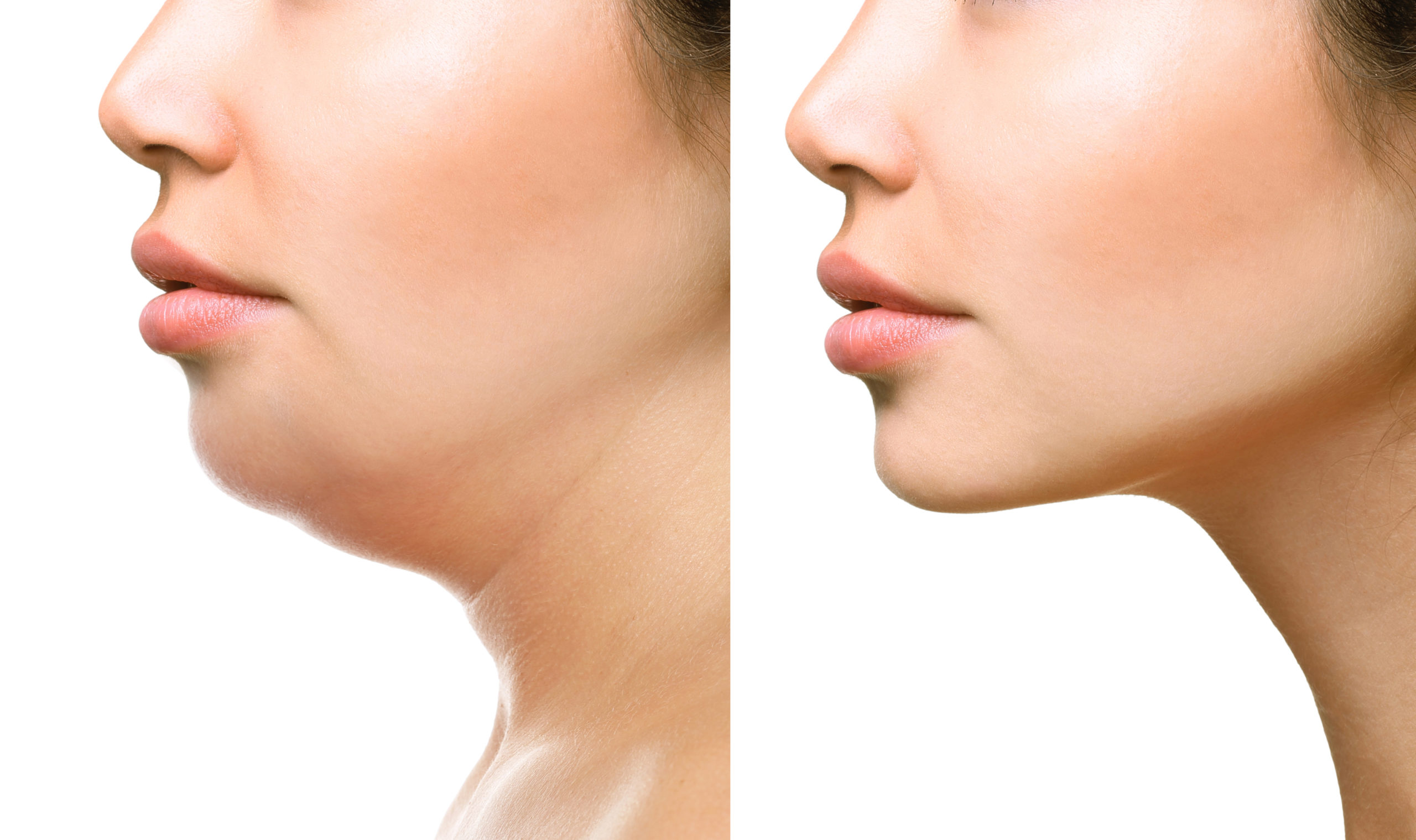 how much is kybella